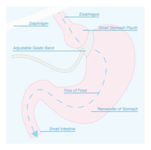 gastric band