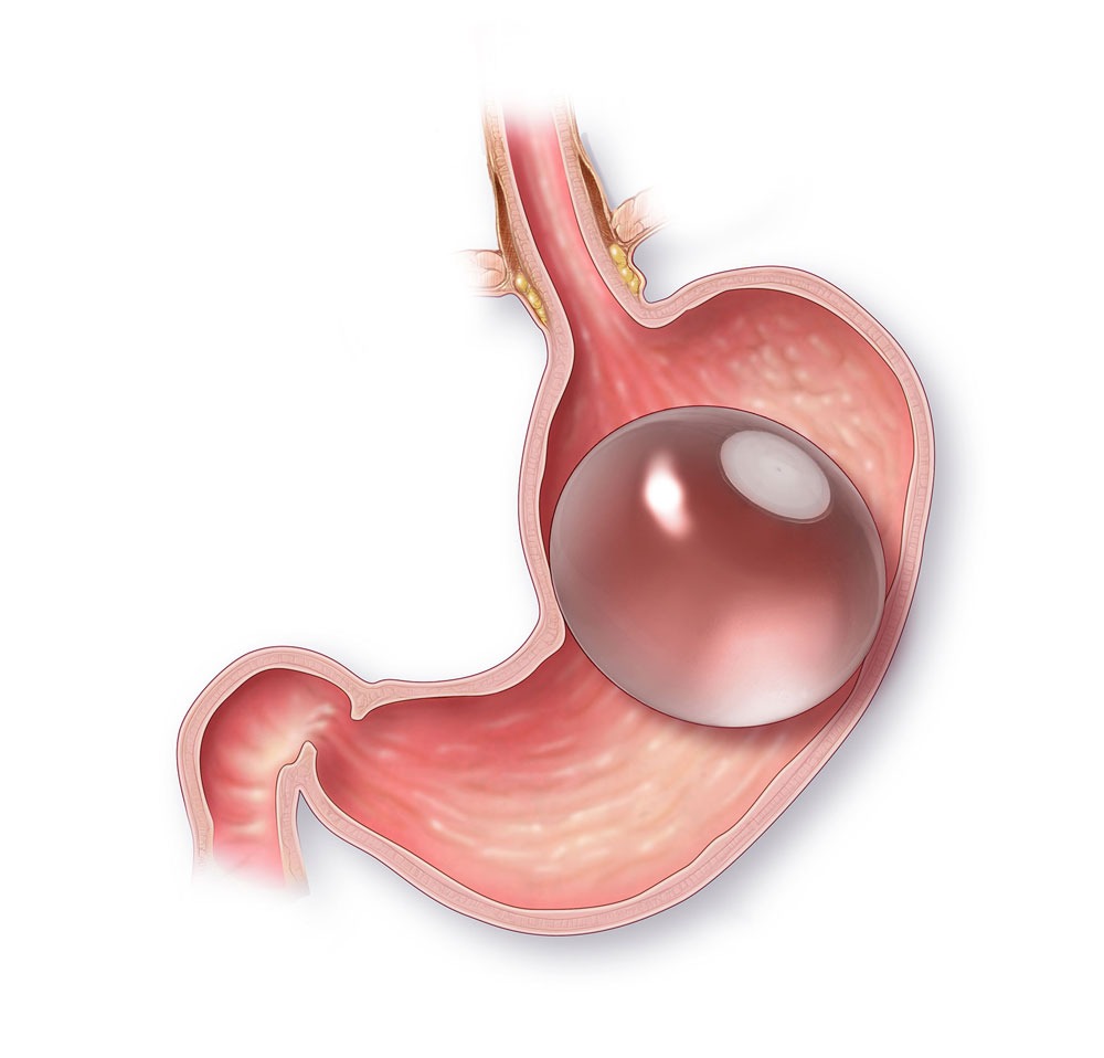 Gastric Balloon Risks procedure