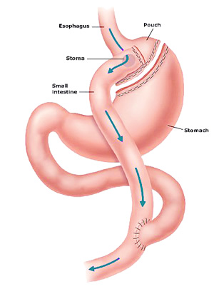 Gastric band problems gastric bypass surgery