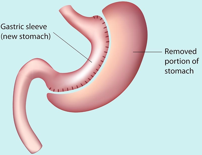 Gastric band problems sleeve gastrectomy