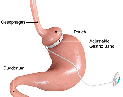 Gastric band problems unveiling