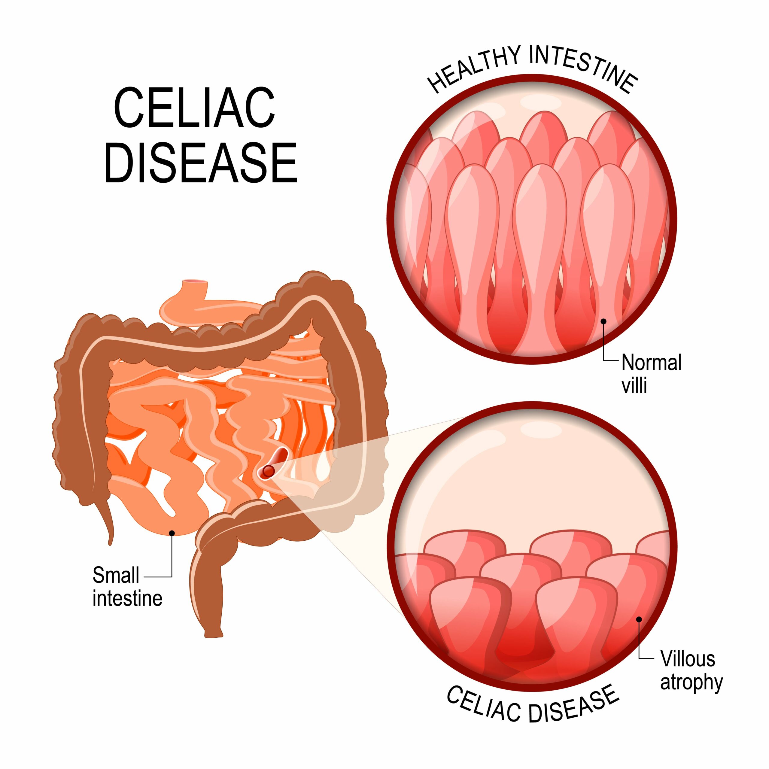 gluten free diet myth celiac disease