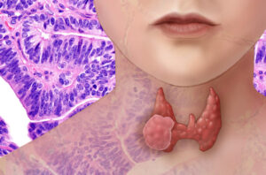 ozempic side effects thyroid cancer
