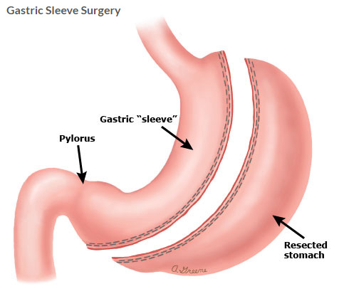 risks of sleeve gastrectomy understanding