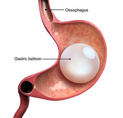 Gastric Balloon Risks what is